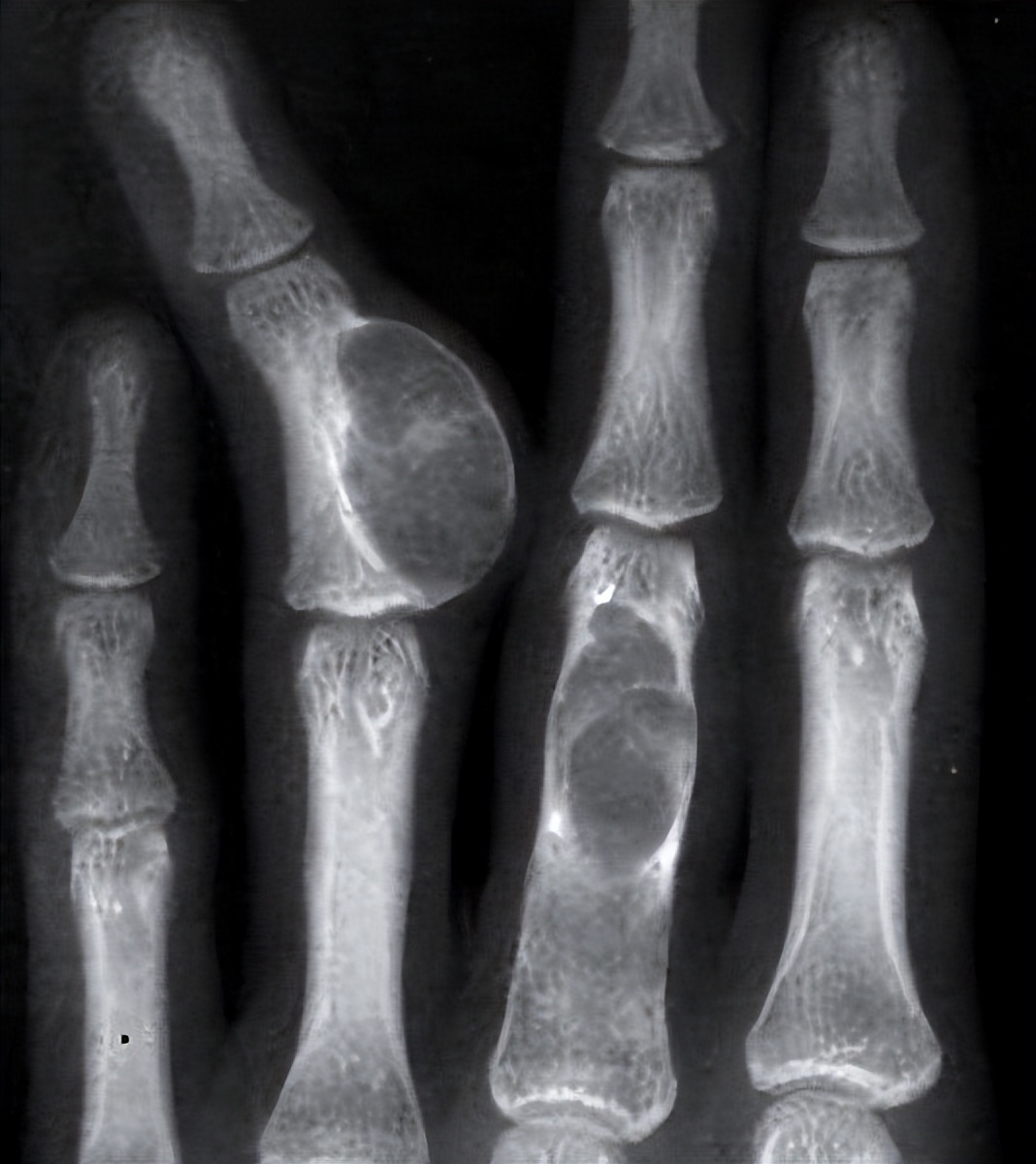 河北19岁女孩抗癌,清华女学霸患癌之后积极抗癌