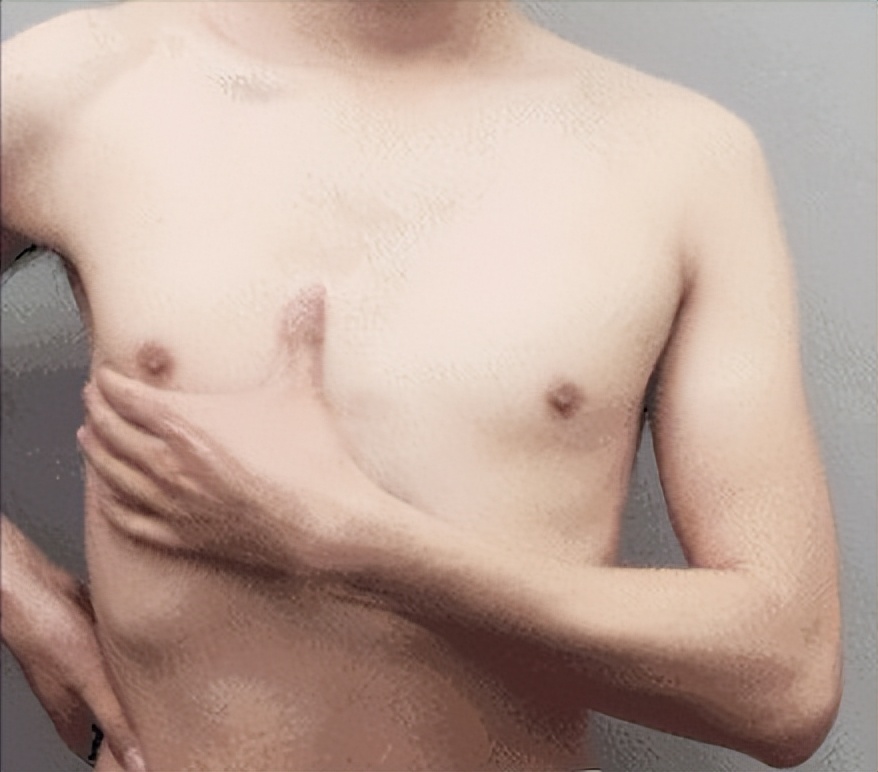 男生胸部太大的原因,男生的胸部大的原因