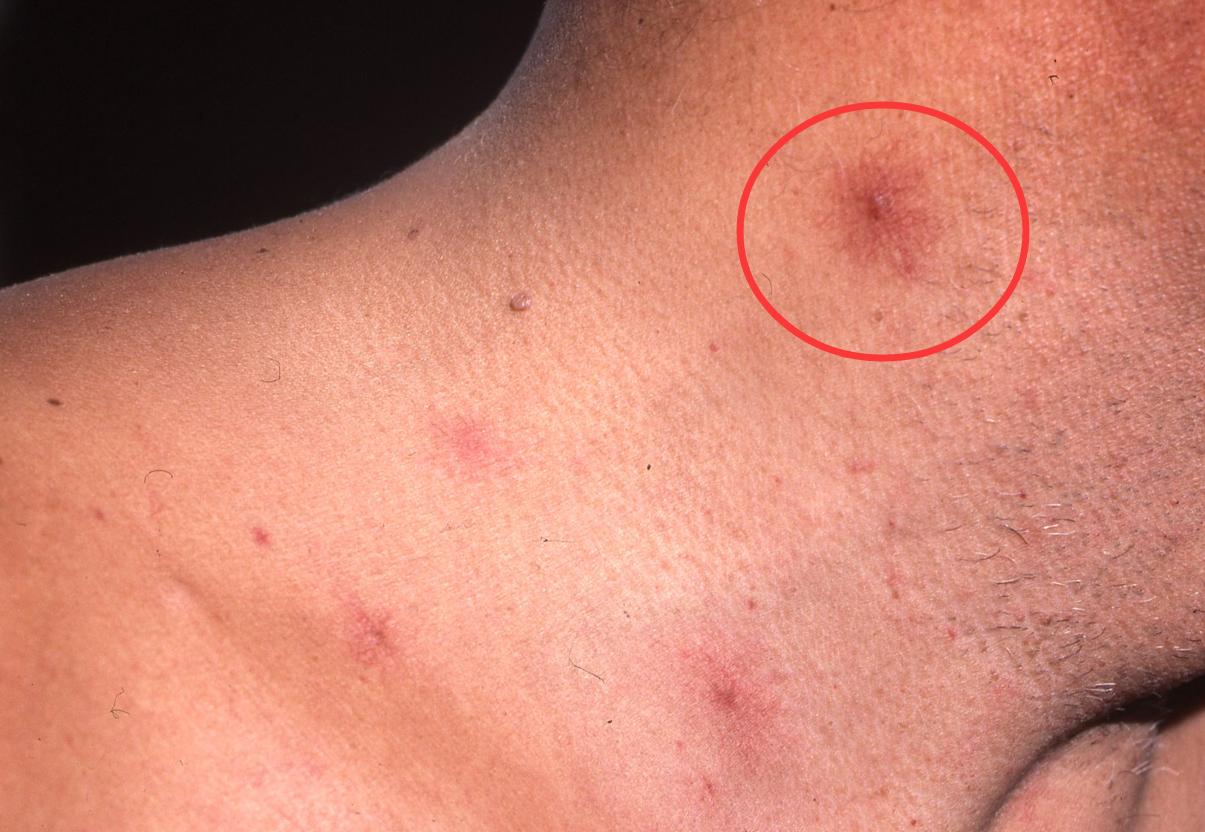 肝脏出问题皮肤痒是什么样子,肝脏疾病引起的皮肤瘙痒如何医治