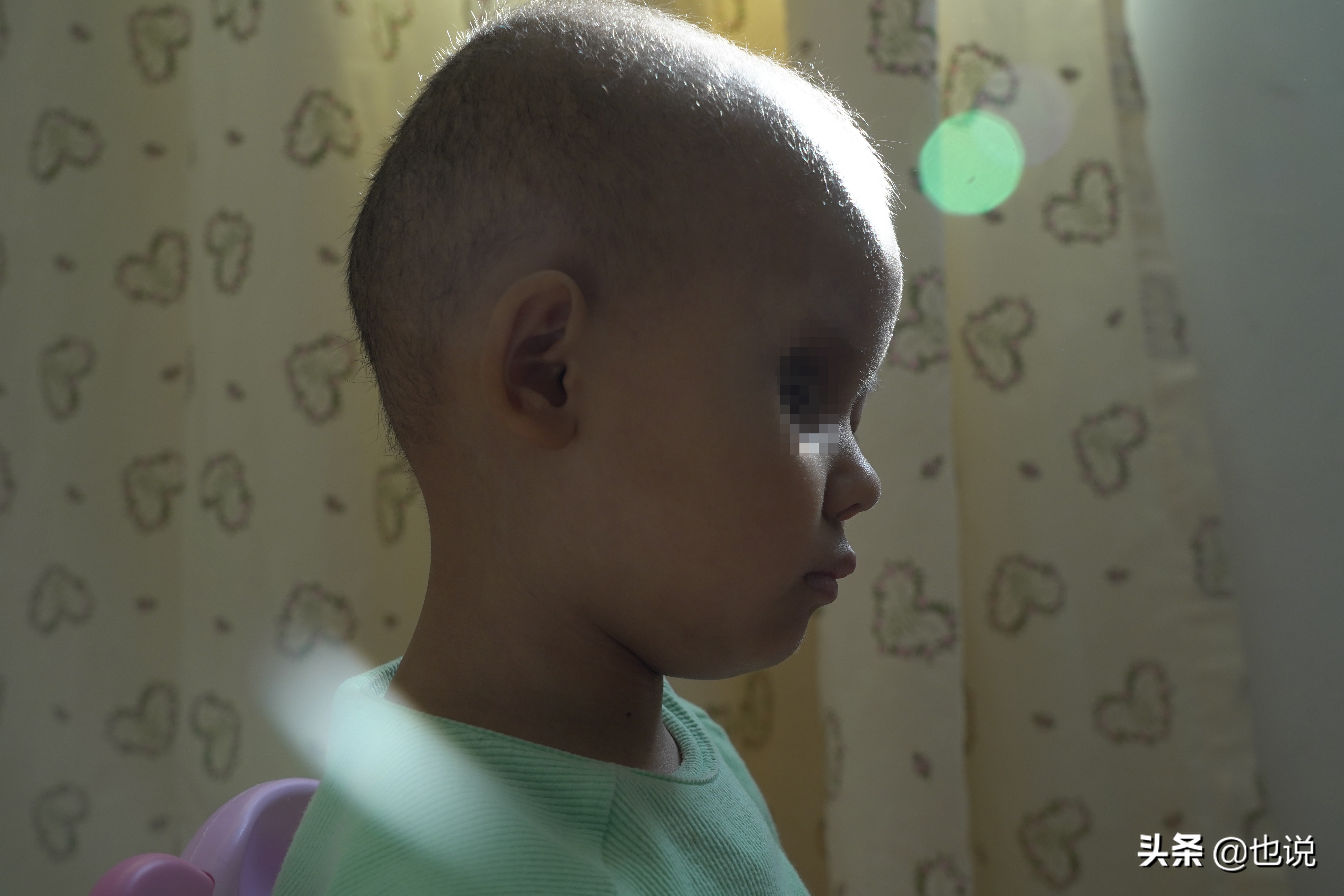 5岁女孩眼癌左眼摘除又遇血癌,五岁女童眼睛摘除又得血癌