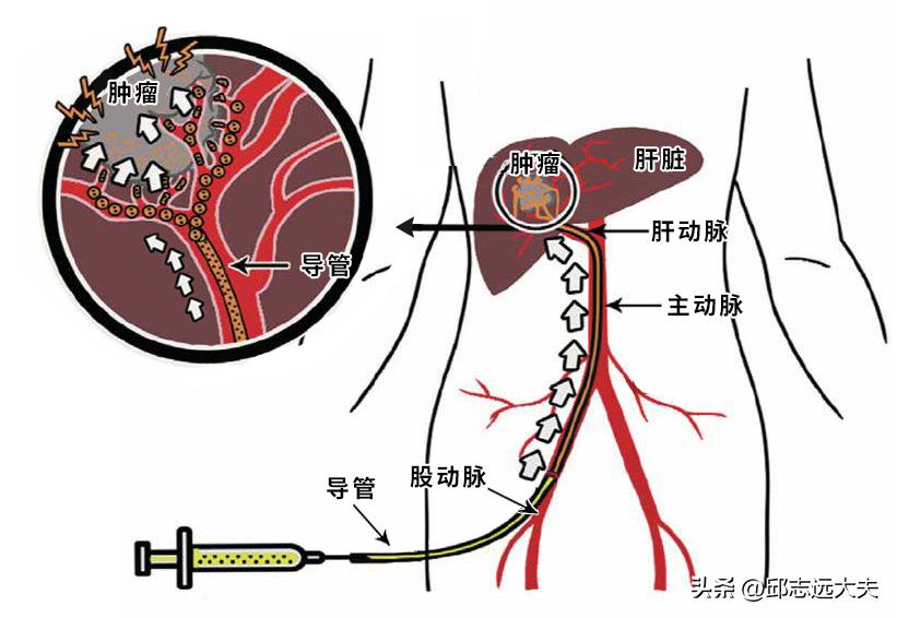 肝癌tace介入手术动画,肝癌tace介入多久取管