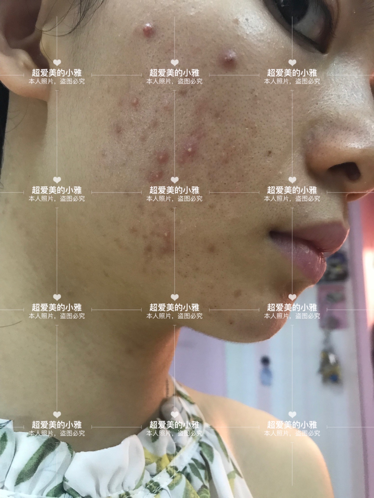 痘痘严重爆发如何战痘到底,痘痘的常见问题解决方法在这里