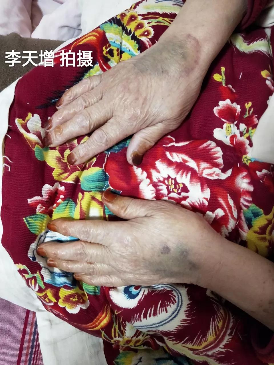 40岁女性手背开始很多皱纹怎么办,手背皮肤松弛皱纹多粗糙是啥原因