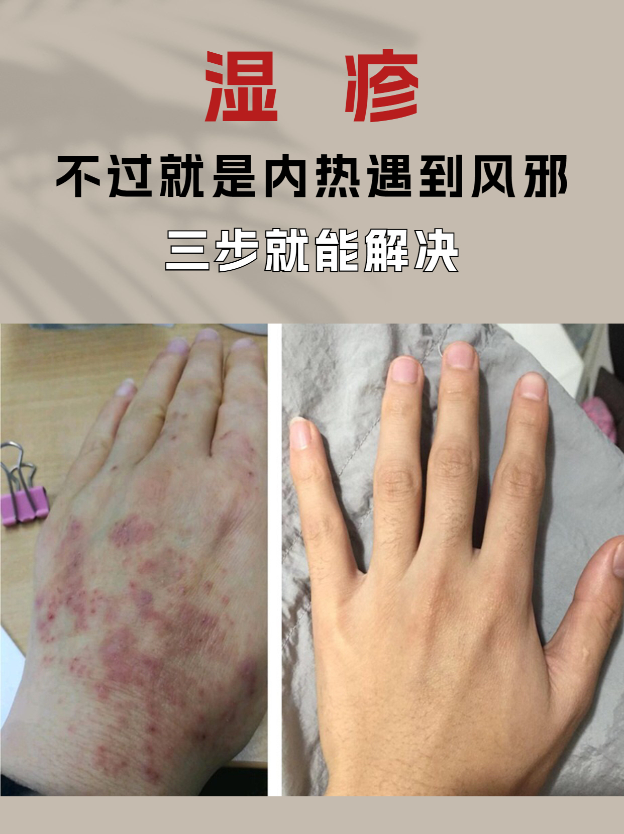 如何判断湿疹是湿邪还是风邪,风邪湿疹最佳治疗方法