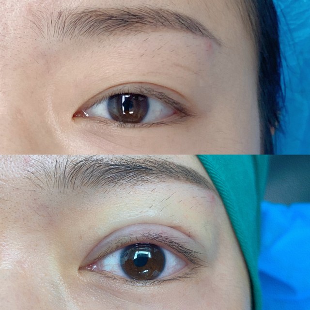 北京一女子整形,北京女子双眼皮手术效果