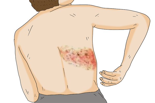 接种带状疱疹疫苗可以用医保卡吗,带状疱疹疫苗多大年龄接种比较好