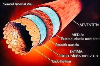 血管壁形成粥样斑块该怎么办,血管内壁增厚是什么原因
