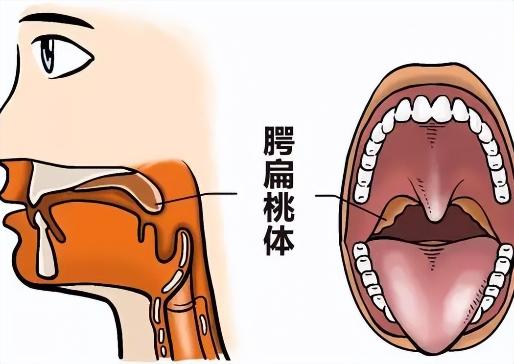 扁桃体发炎挂呼吸科,扁桃体老是发炎中医怎么调理