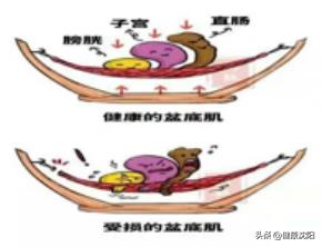 女性盆底健康筛查,妇女盆底健康知识