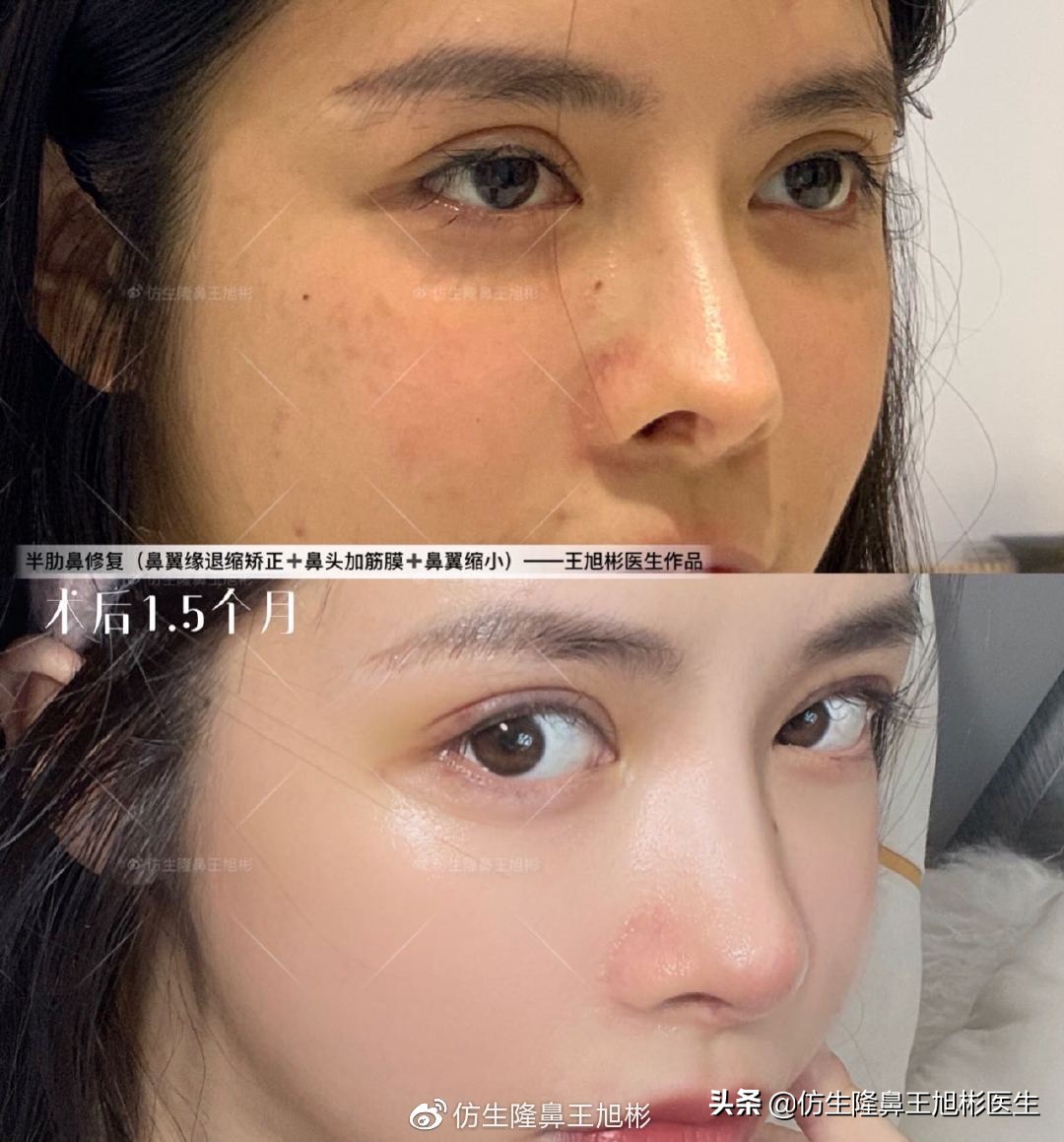 常见鼻部整形美容项目,整形鼻和自然鼻