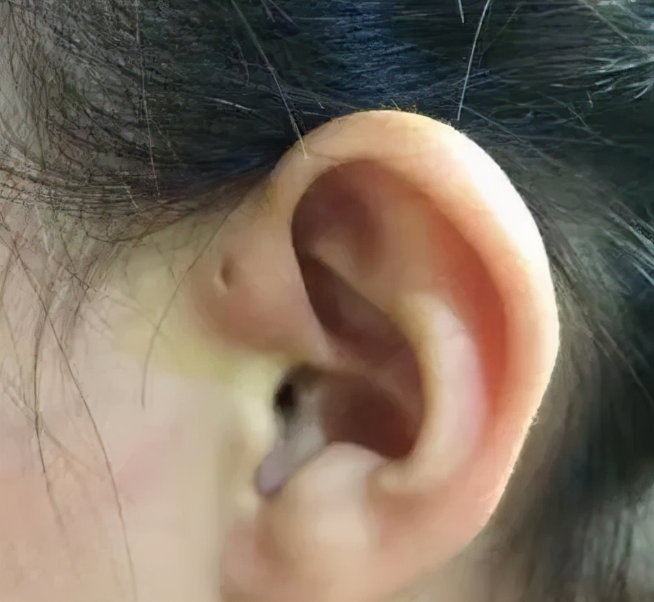 什么癌症需要造瘘,什么癌严重了需要造瘘