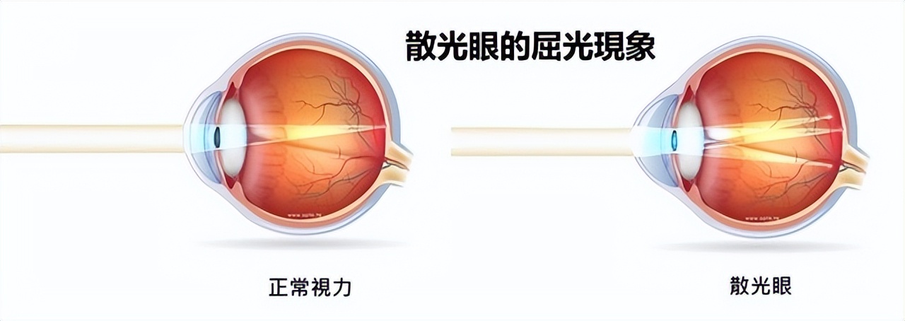 散光是怎么处理镜片的,散光眼镜保养