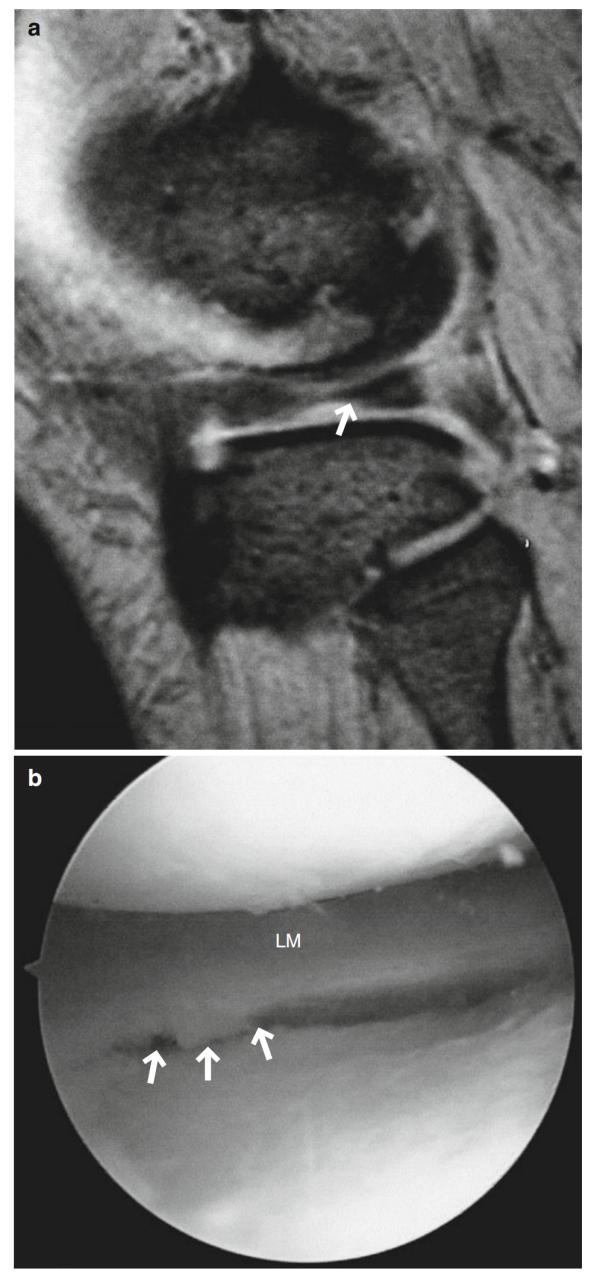 磁共振诊断半月板撕裂但没有症状,半月板桶柄状撕裂磁共振影像表现