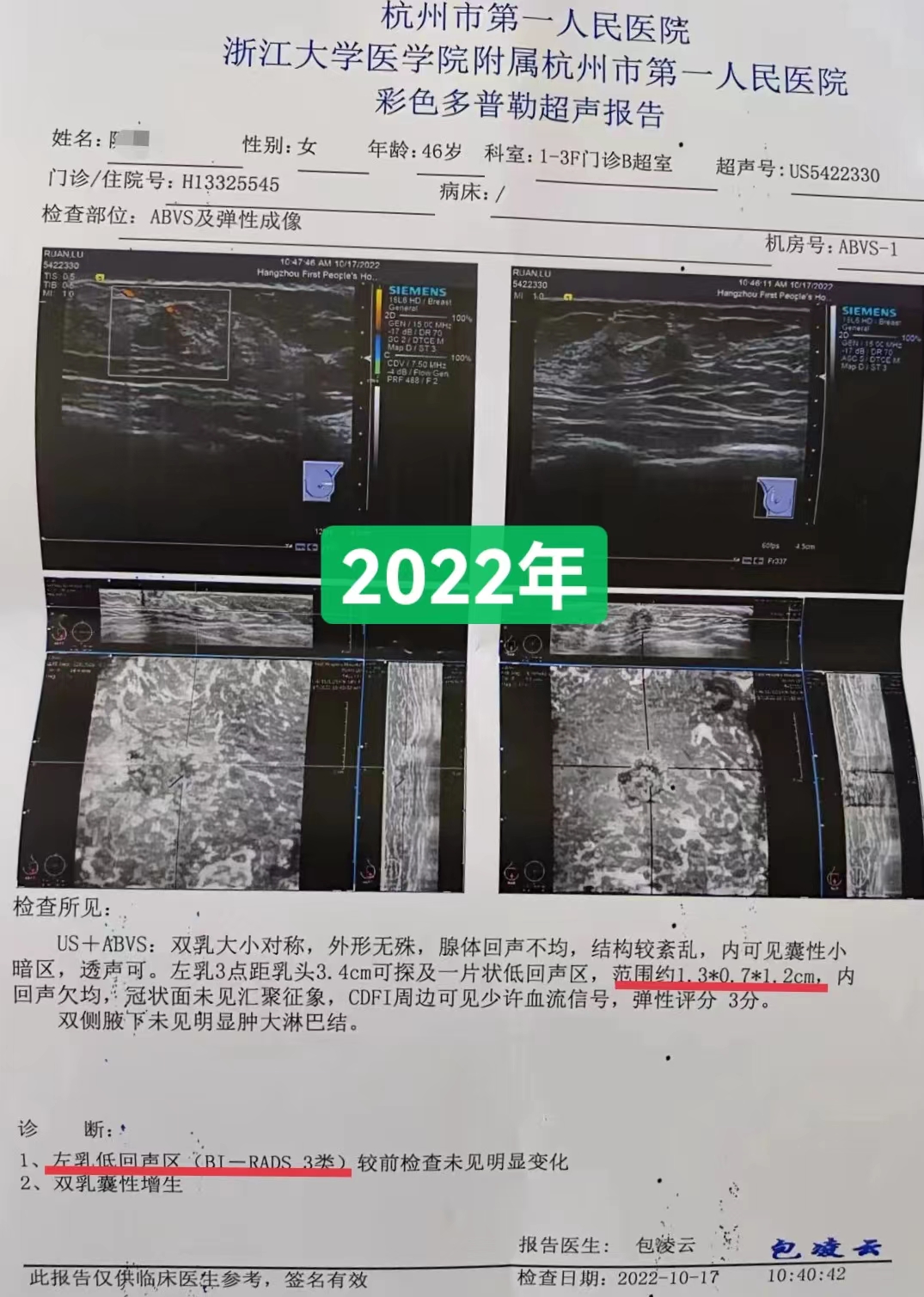 46岁患者乳腺结节3类，服用三个月中药后结节消失