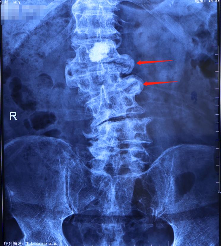 脊柱侧弯腰椎变性,70岁老人腰椎侧弯严重