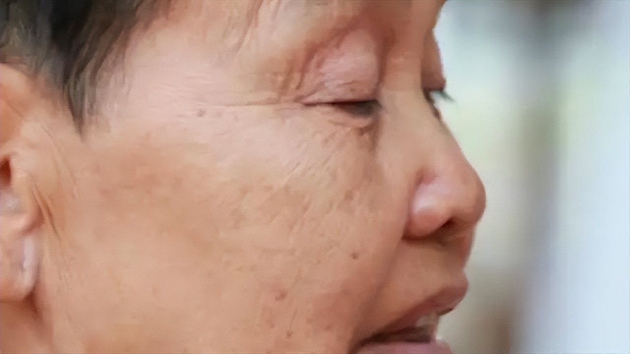 什么药可以去老年斑最有效,老人斑用什么药膏擦最有效