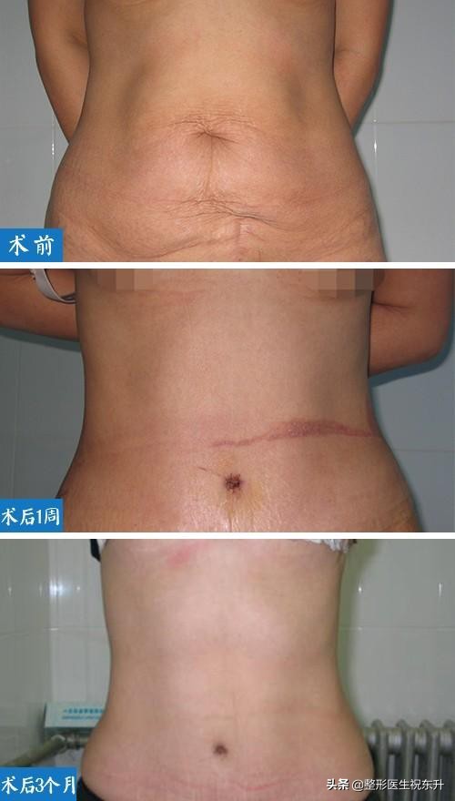 做完腹壁整形有什么好的改善,说说做手术感受