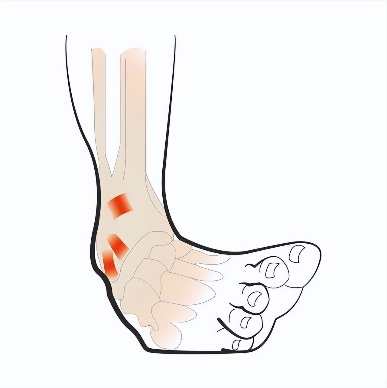 滑雪滑了不小心滑倒留疤,滑雪膝关节反向扭伤