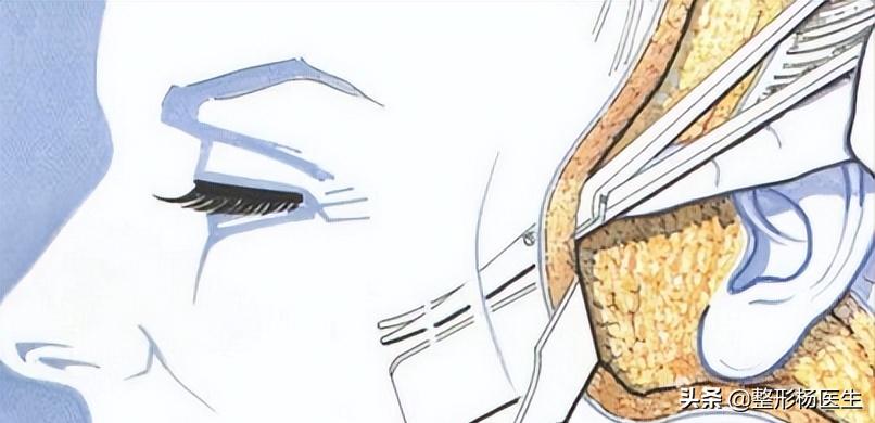 做大拉皮手术会不会衰老得快,大拉皮手术需要多少时间