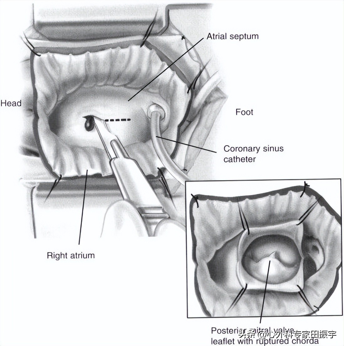 二尖瓣成形术要多少钱,二尖瓣成形术后抗凝多久