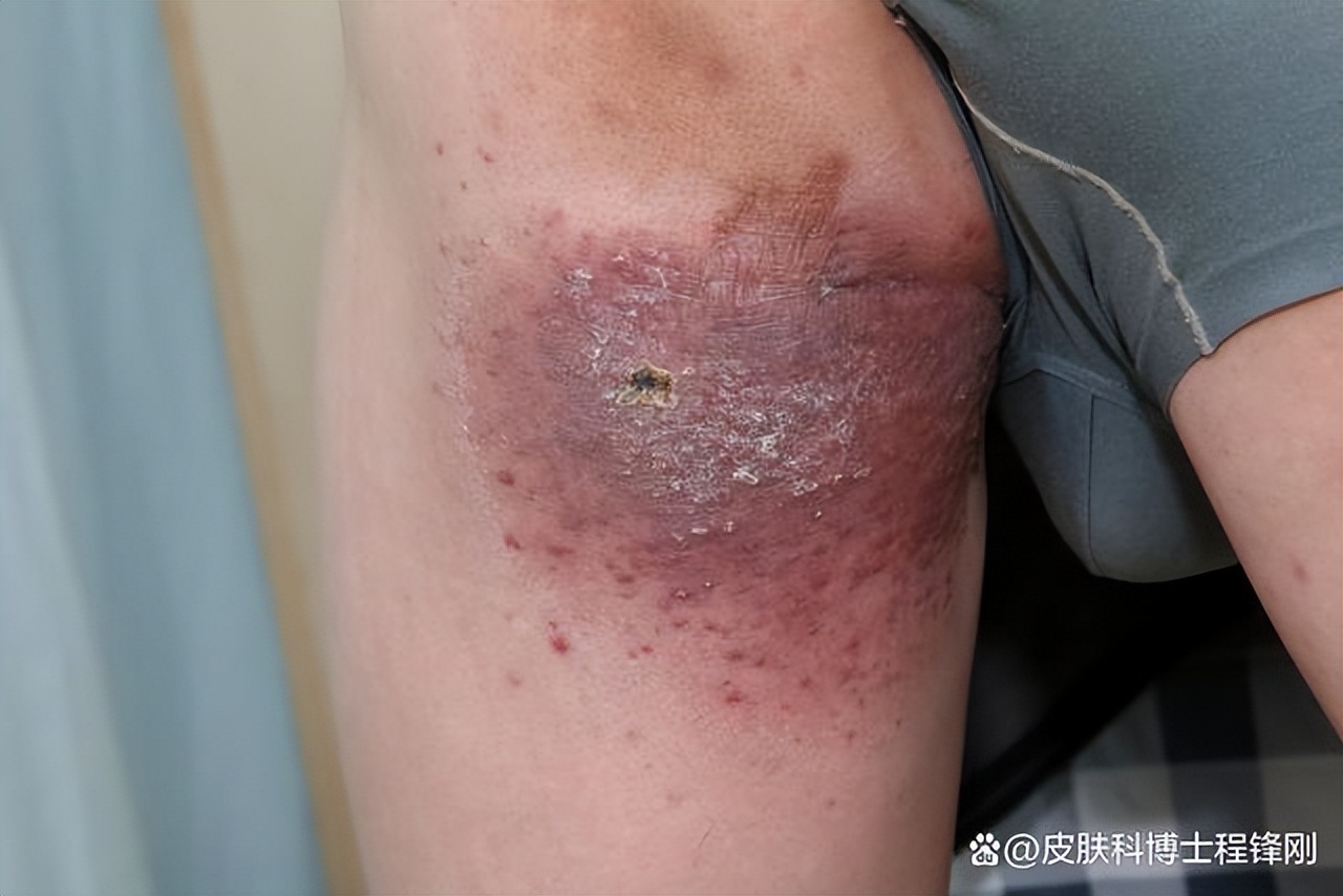 大腿两侧一小块红斑是什么皮肤病,大腿内侧一大片红癣