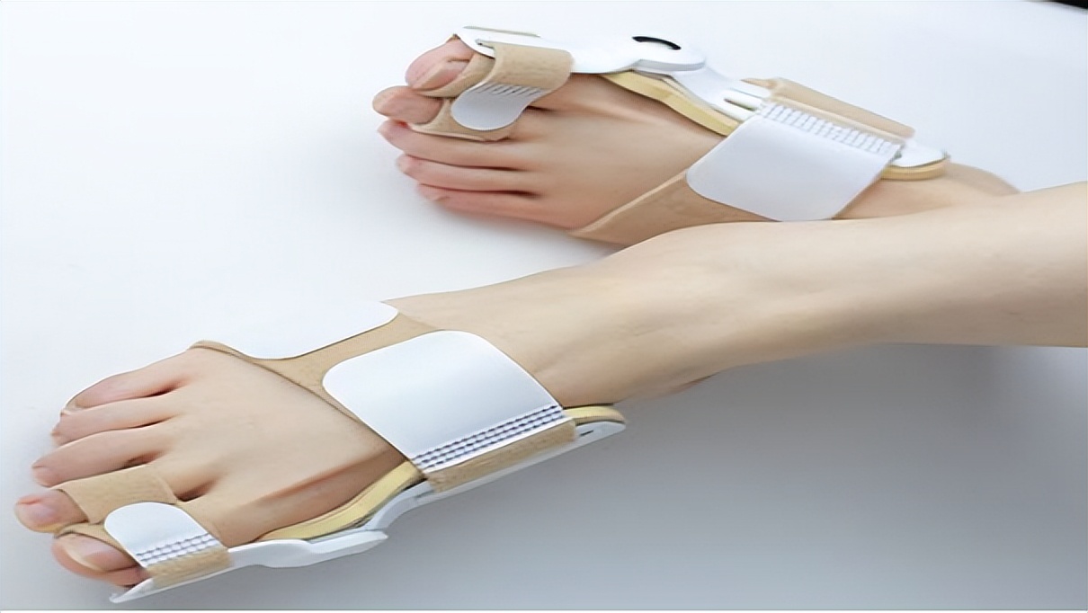 大拇脚趾往里歪怎么矫正,严重拇外翻脚趾畸形怎么办