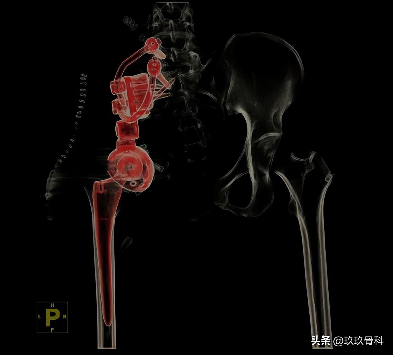 力达康定制型模块化假体治疗“肿瘤切除术后半骨盆缺损”