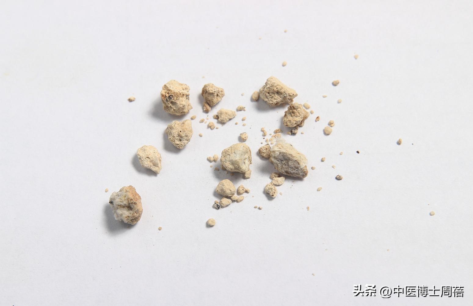 查出胆结石，并非一定要手术，这4类患者，更适合中医保守治疗