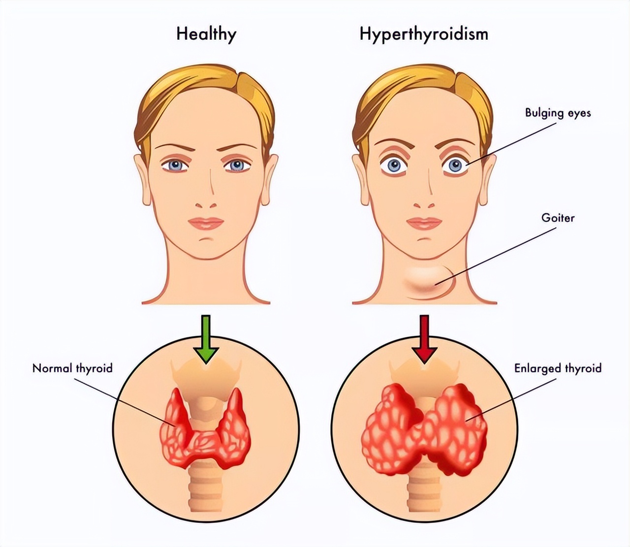 引起甲亢危象的原因是哪些,更年期甲亢是什么原因引起的
