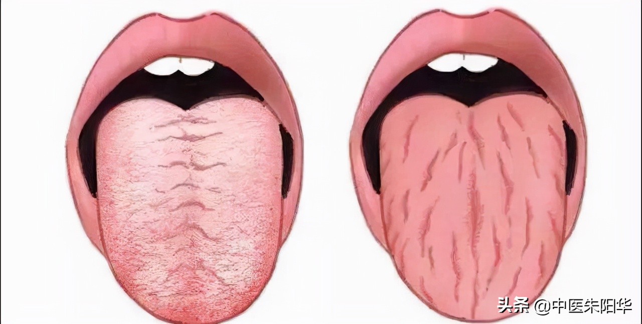 舌有裂纹的中医辨治,舌有裂纹吃什么中药调理