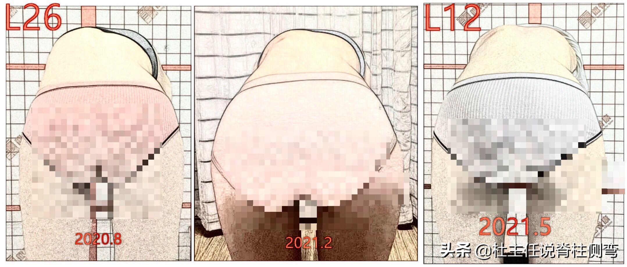 脊柱侧弯超过60度,还能选择保守治疗改善吗?恢复效果如何?