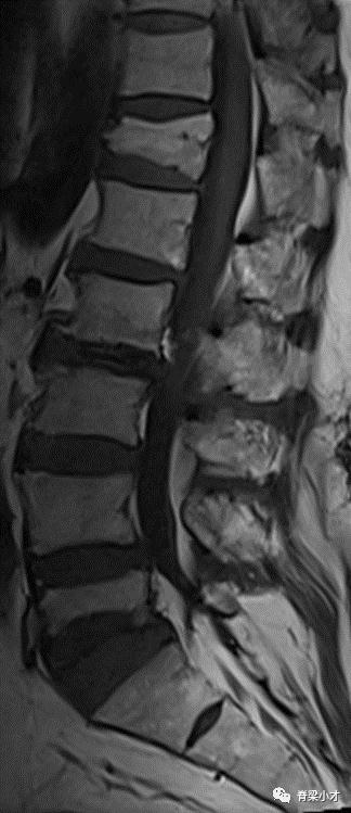 腰椎间盘突出症的诊断与鉴别,腰椎间盘突出和膨出的区别在哪里