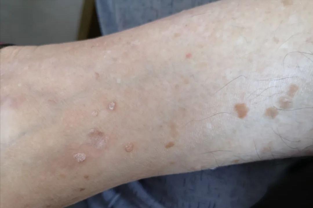 hpv和艾滋病怎么传染,hpv和疣有什么关系