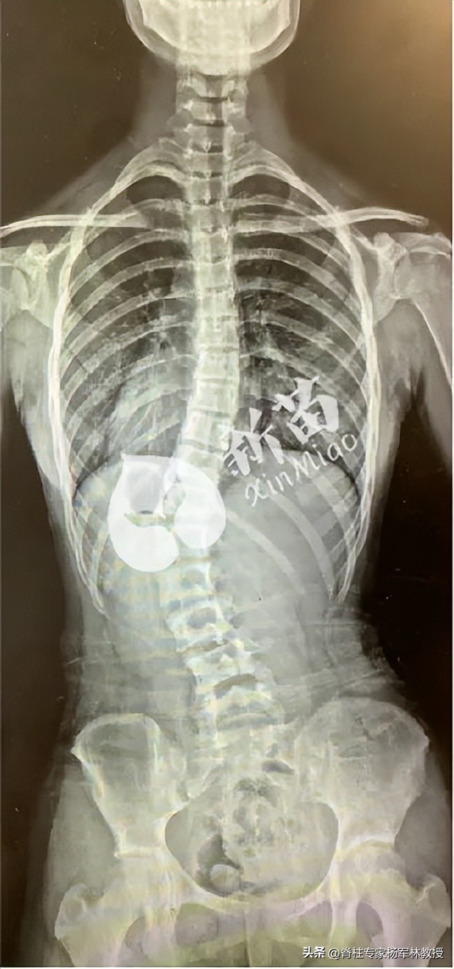 脊柱侧弯高低肩不明显,后背可以看出脊柱侧弯么