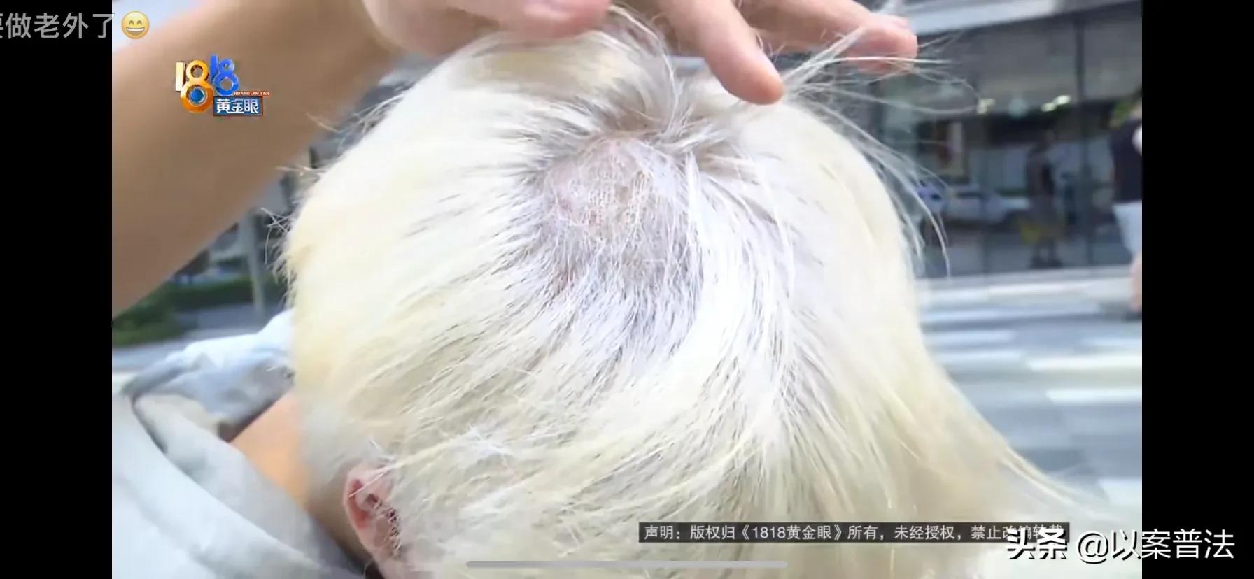 好好的头发,俊俊的一位姑娘,染完色就莫名秃顶了