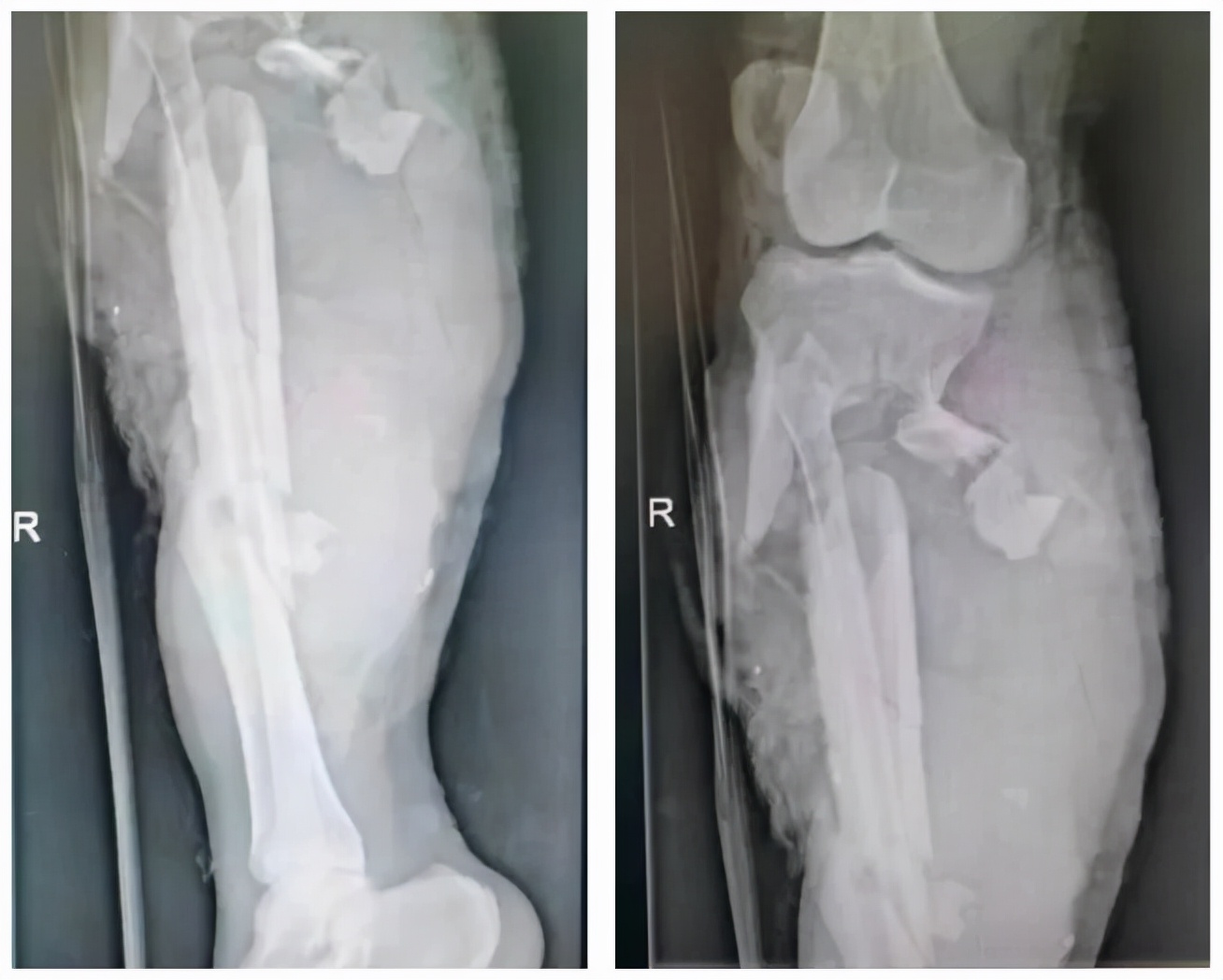 鍖荤枟鍣ㄦ淇濇姢鑳宠唺鏀灦,澶栫鍖荤敓鎽旈鎶樻晳鎻寸幇鍦烘搷纰庡績