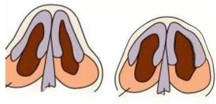 鼻子歪了不通气怎么办,歪鼻矫正改善通气