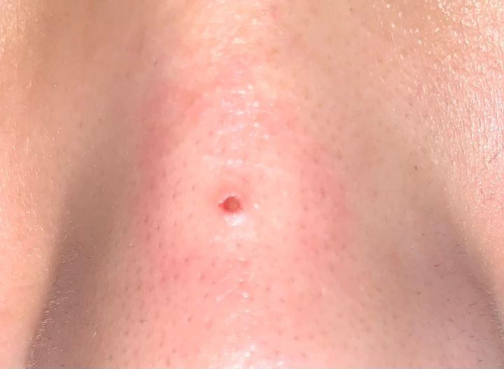 美容院清洁黑头会让毛孔变大吗,黑头拔了毛孔变大会自己愈合吗