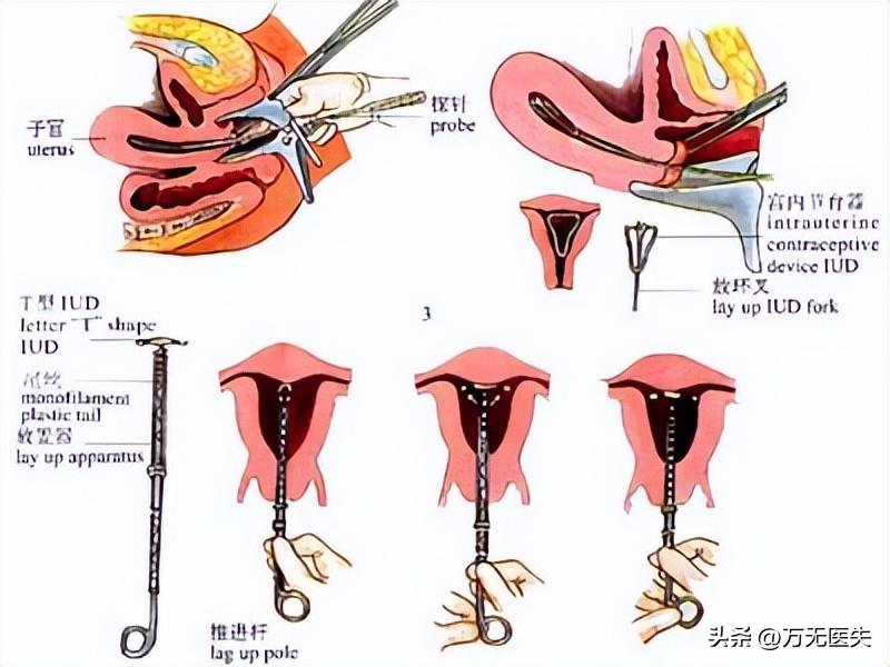 女性上环的全过程，看完心疼了！男女都要好好看看，珍惜眼前人！
