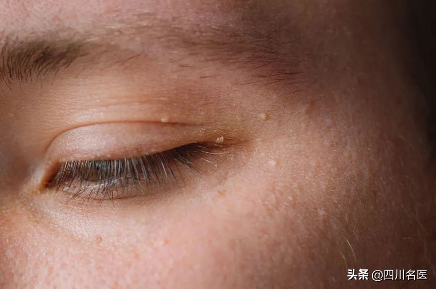 眼睛下面的粟丘疹能去掉吗,眼睛周围长的小米粒是啥