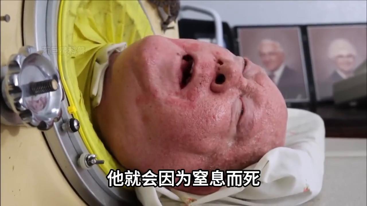 世界上最后一个铁肺人后续,最后一个铁肺人现状