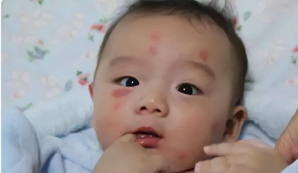 宝宝被蚊子咬了肿痒擦什么,宝宝被蚊子咬特别肿怎么办