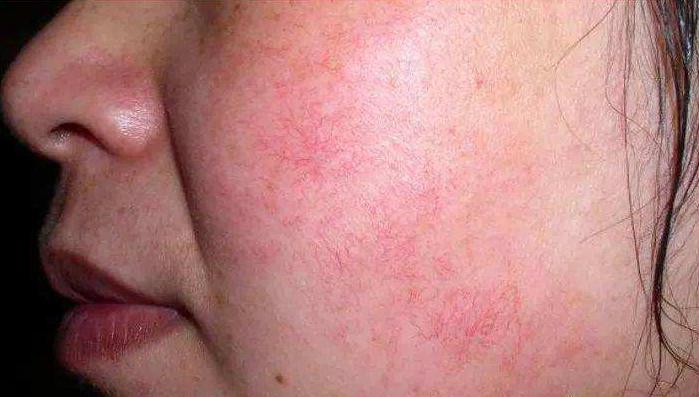 脸部皮肤过敏又红又疼,脸部皮肤过敏红瘙痒怎么办