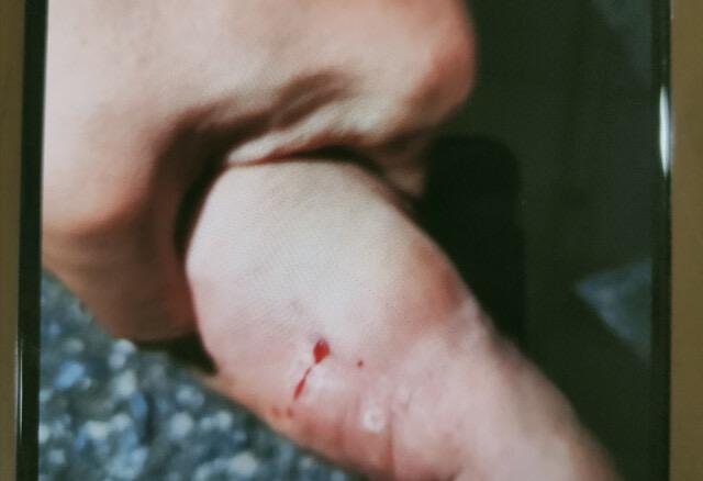 好危险！湖南一老人被剧毒“土公蛇”咬伤！这是什么蛇？有多毒？