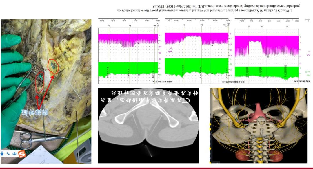 阴部神经电针刺激联合盆底肌锻炼治疗前列腺癌术后尿*禁失**