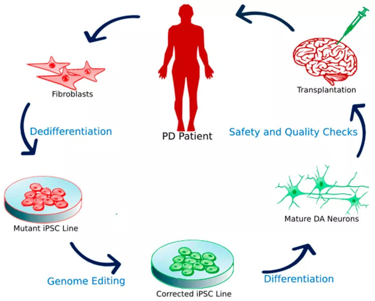 干细胞治疗帕金森技术的最新突破,干细胞治愈帕金森成功案例
