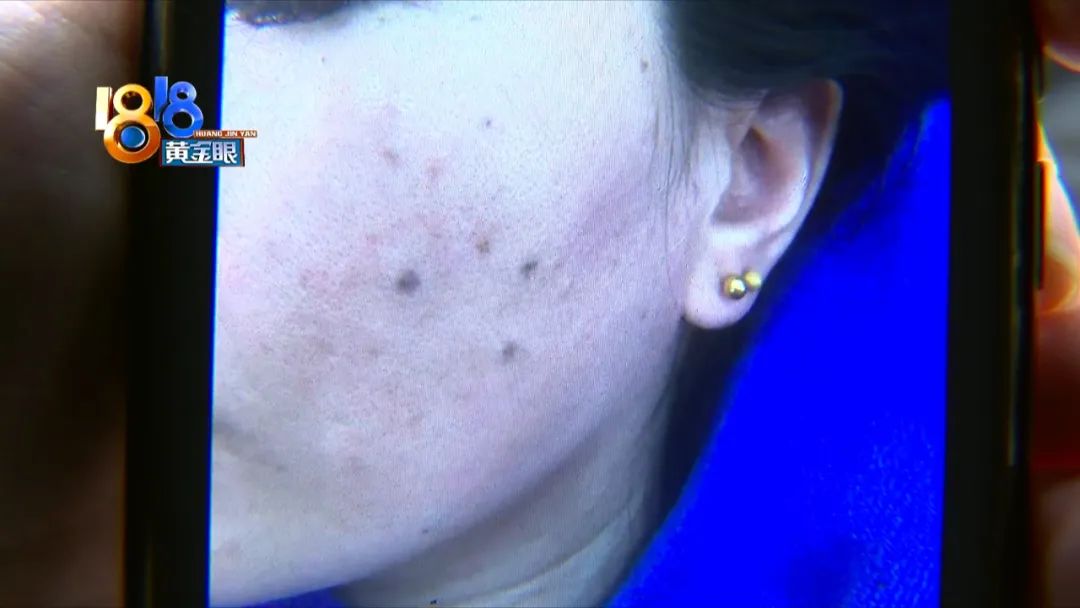 顾客说点痣后留坑怎么回复,激光点痣太深留下坑