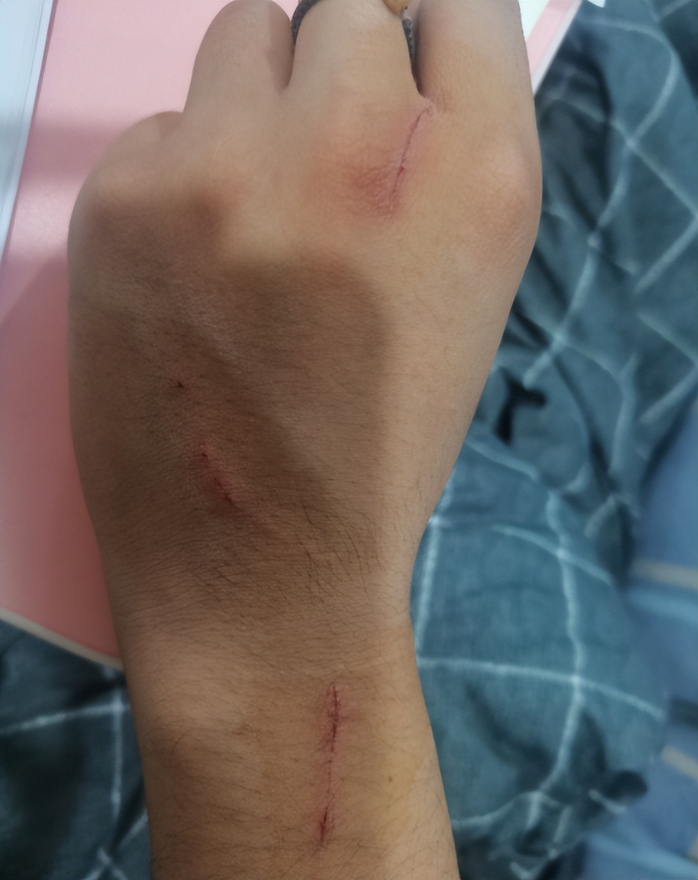 被猫抓伤在家怎么自救,被猫抓伤如何自救