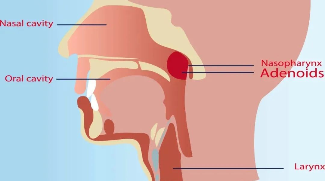腺样体肥大的微创治疗,腺样体肥大做消融术还是切除术