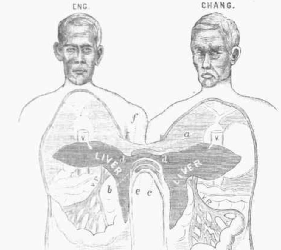 连体人该怎么结婚生子,邦克兄弟连体人
